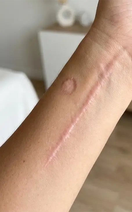 Dermopigmentation correctrice pour masquer les cicatrices sur le corps à Narbonne.