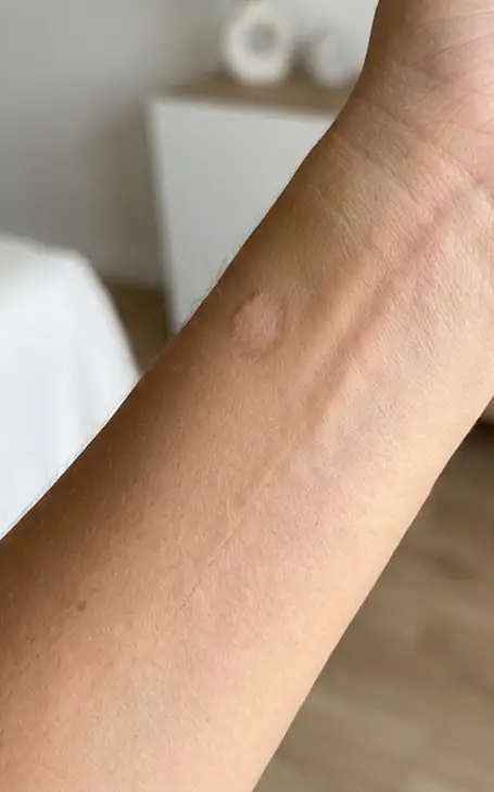 Dermopigmentation correctrice pour masquer les cicatrices sur le corps à Narbonne.