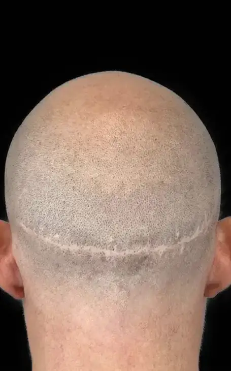 Résultat bluffant pour cacher une calvitie homme grâce à la tricopigmentation.