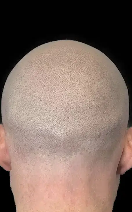 Comment cacher une cicatrice d'implant capillaire avec la tricopigmentation à Narbonne.