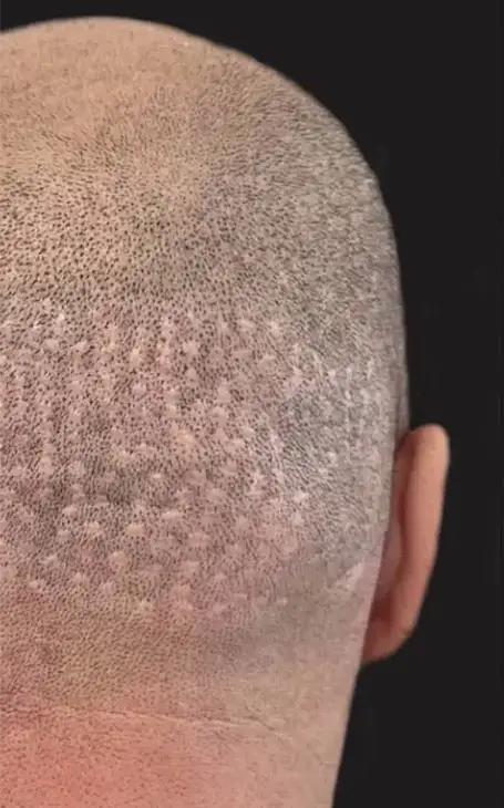 Comment cacher une cicatrice d'implant capillaire avec la tricopigmentation à Narbonne.