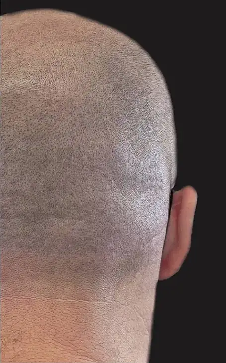 Comment cacher une cicatrice d'implant capillaire avec la tricopigmentation à Narbonne.