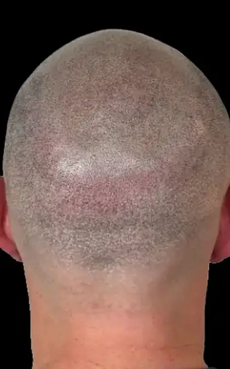 Comment cacher une cicatrice d'implant capillaire avec la tricopigmentation à Narbonne.