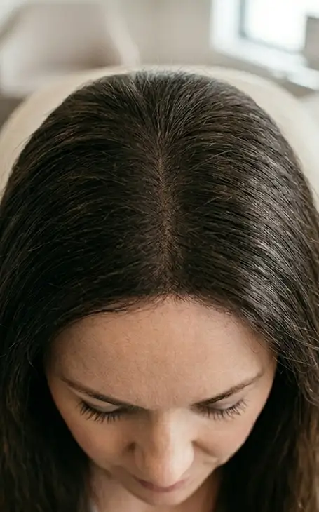 Technique efficace pour cacher la calvitie naissante sans chirurgie à Narbonne.