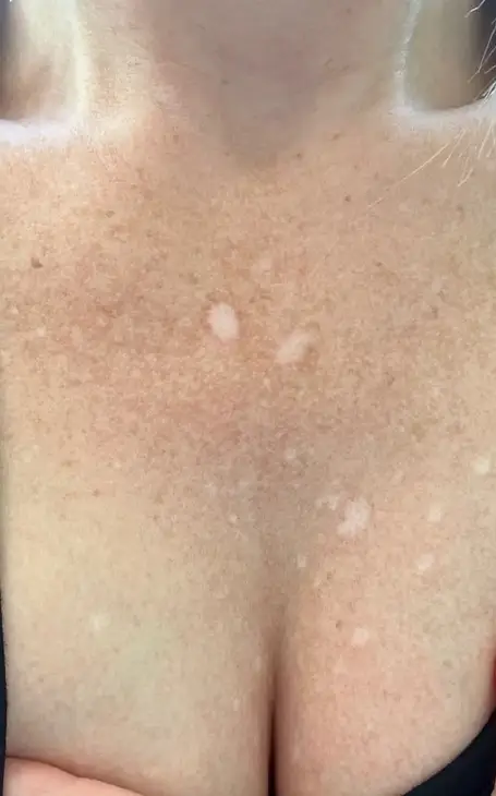 Solution durable pour masquer les vergetures rouges ou blanches sur le corps.