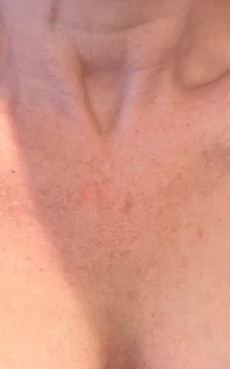 Solution durable pour masquer les vergetures rouges ou blanches sur le corps.