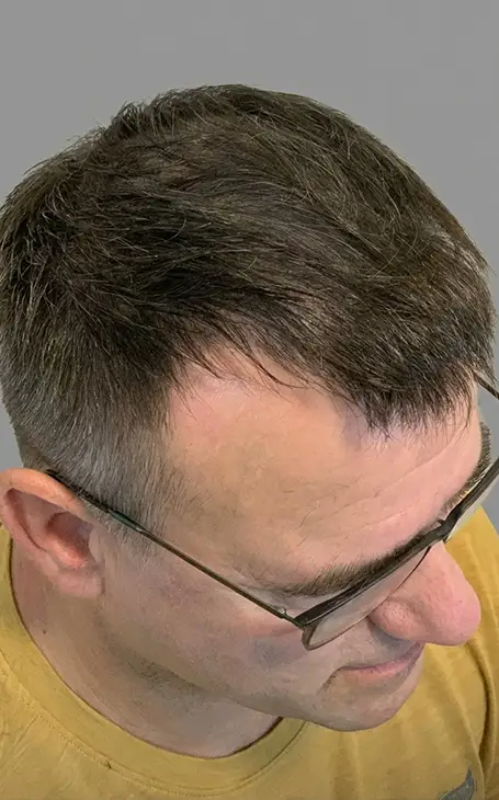Résultat naturel tricopigmentation calvitie homme à Narbonne.