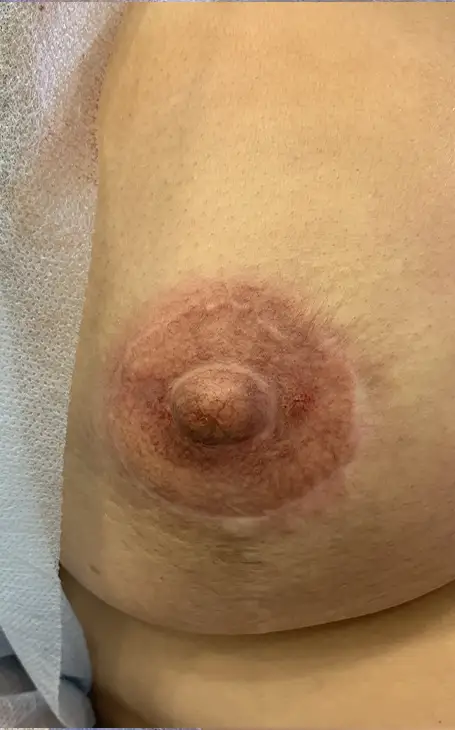 Dermopigmentation aréole mammaire et reconstruction à Narbonne.