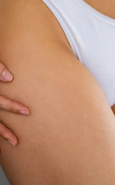 Atténuer et cacher les vergetures par tatouage médical chez Alice Da Costa.